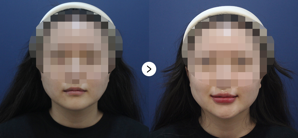 케이톡스 전후사진