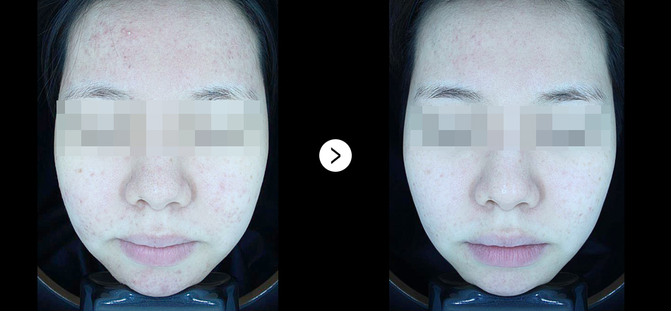 케이톡스 전후사진