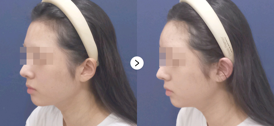 케이톡스 전후사진