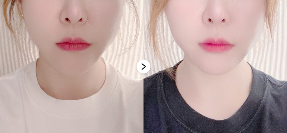 케이톡스 전후사진