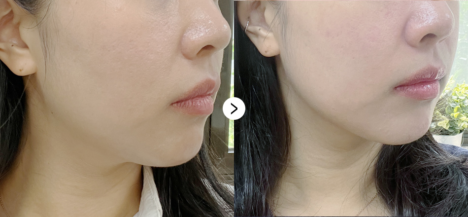 케이톡스 전후사진