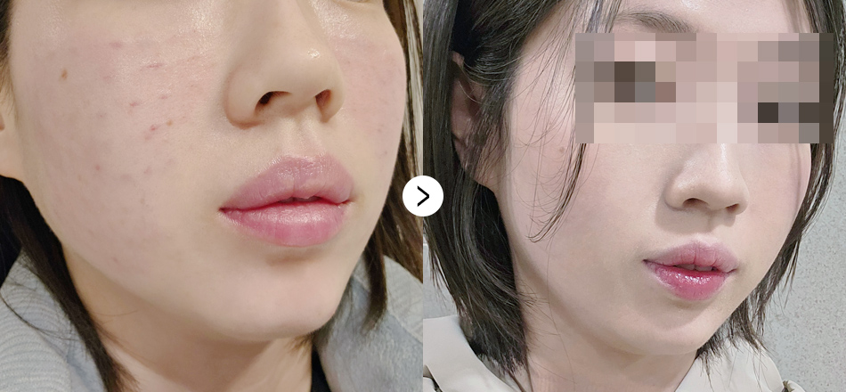 케이톡스 전후사진