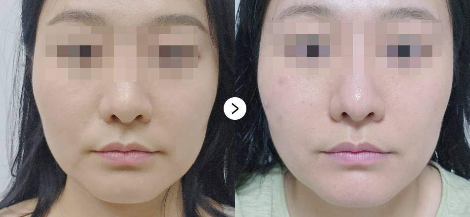 케이톡스 전후사진