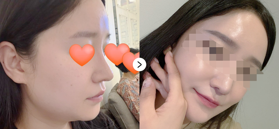 케이톡스 전후사진