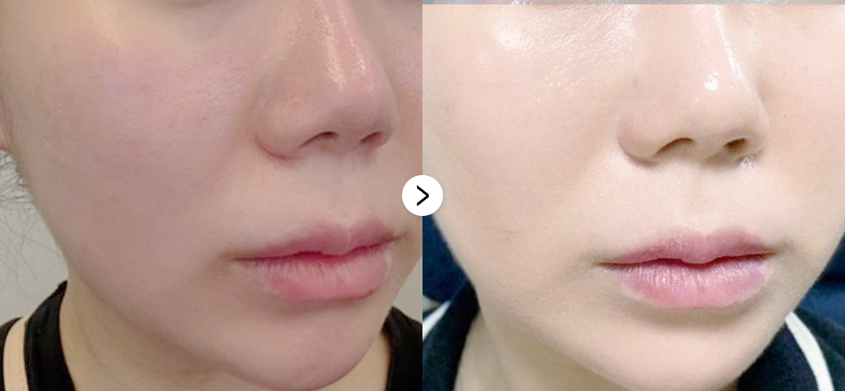 케이톡스 전후사진