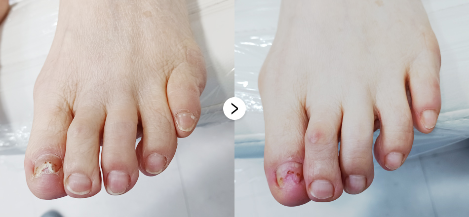 케이톡스 전후사진