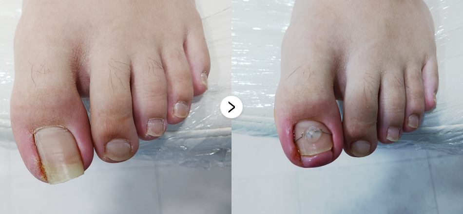 케이톡스 전후사진