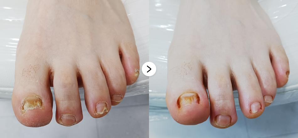 케이톡스 전후사진