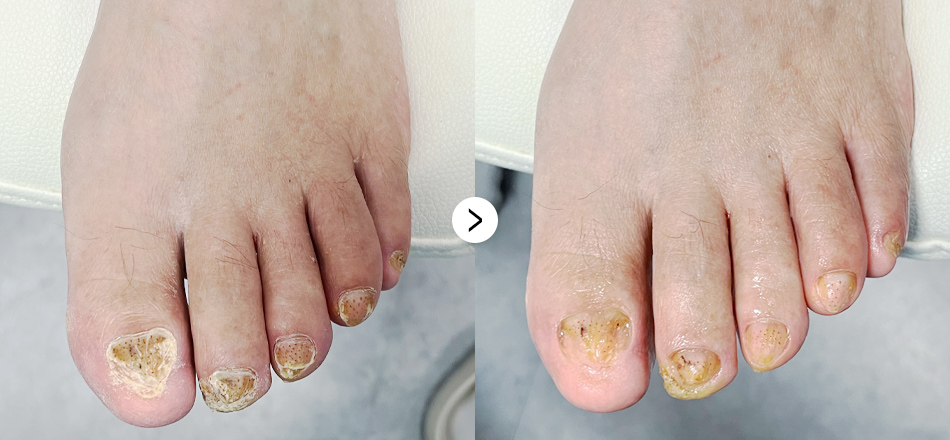 케이톡스 전후사진