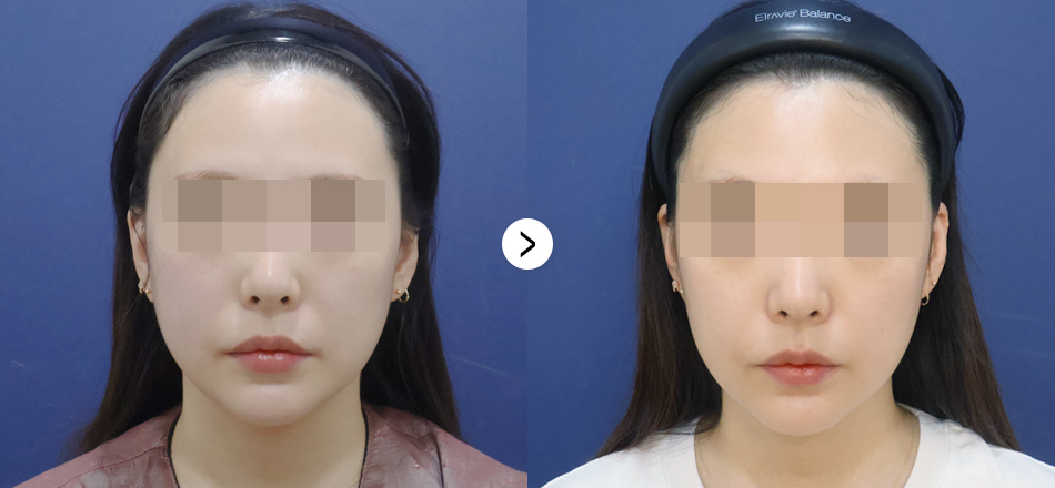 케이톡스 전후사진